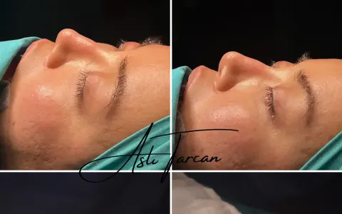 Ethnic Rhinoplasty