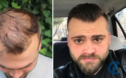 HLC Clinic, Hair Transplant Turkey